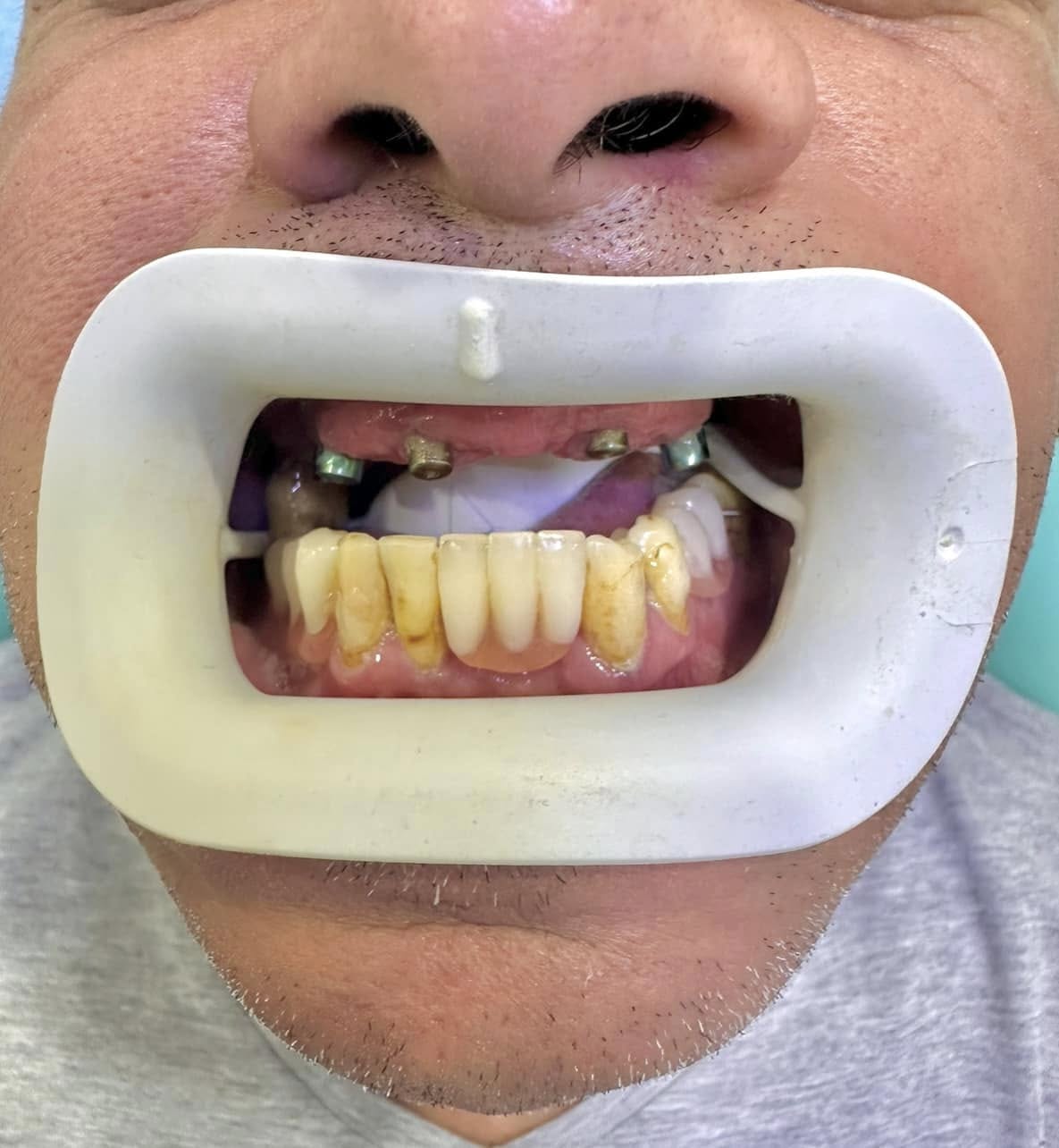 <a href="/services/implants-dentaires" class="internal-link">Implants Dentaires</a> - Avant